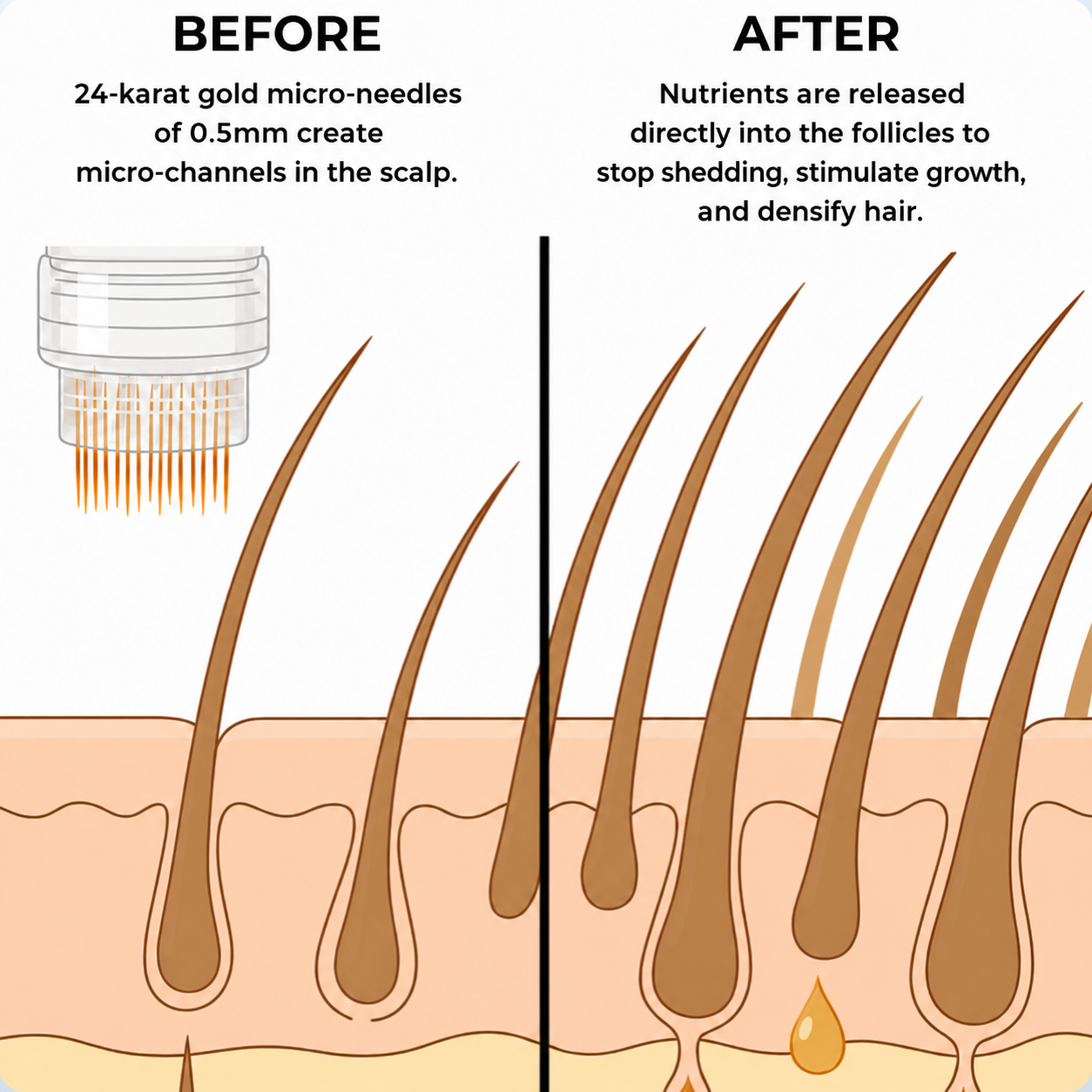 NOVÉLA Micro-Infusion System™
